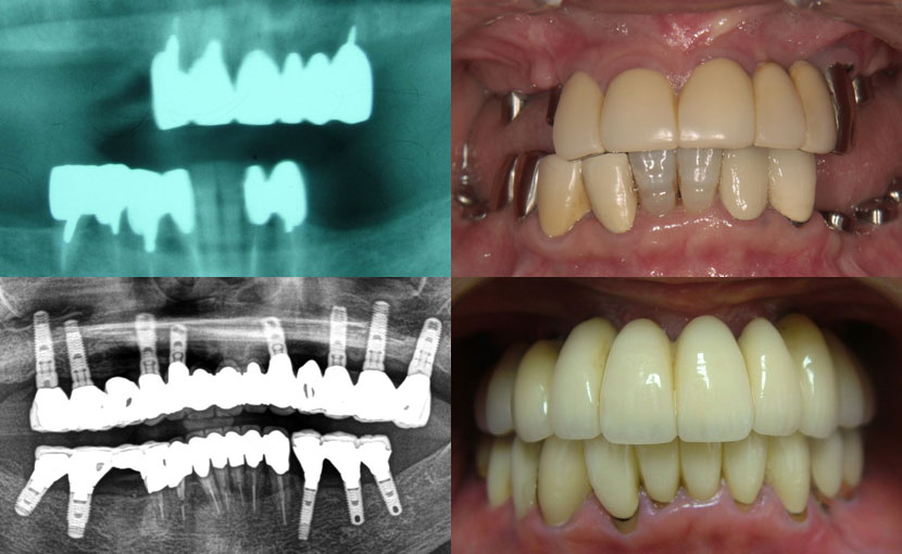 石川｜あかつき歯科医院｜症例集｜多数歯欠損インプラント／60代女性／ノンスモーカー