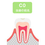 むし歯の治療（詰め物・被せ物など）